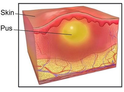 An Abscess or Aposteme