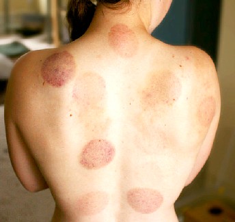 Cupping Bruises