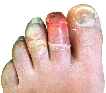 Frostbite of the Toes