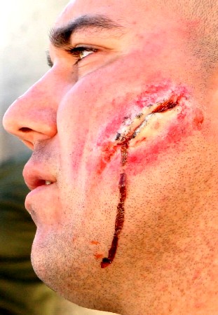 Simulated Bullet Wound to Cheek