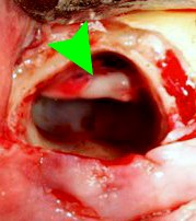 Nerve in Wisdom Tooth Socket