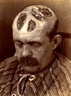 Syphilitic Ulceration of the Scalp