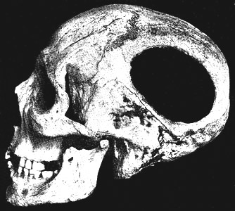 Trepanned Neolithic Skull