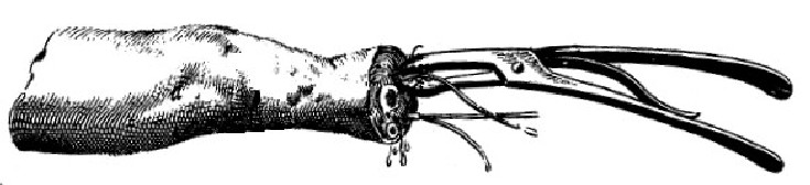 Using Spring Forceps to Extract an Artery