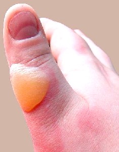 Scald Burn Blister