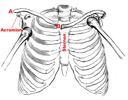 Dislocation of the Collar Bone