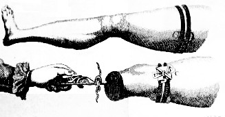 Ligatures in Amputation, Heister