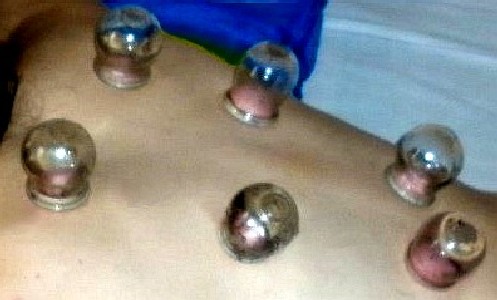 Dry Cupping