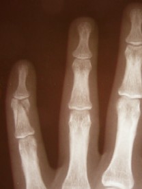 Fracture of Middle Phalanx, Pinky Finger
