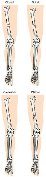 Some Modern Fracture Types