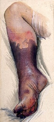 Gangrened Leg - Discolored and decomposing