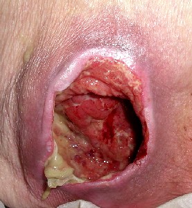 Inflamed Skin Ulcer