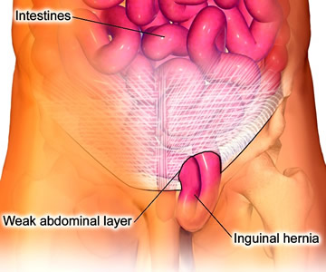 Inguinal Hernia