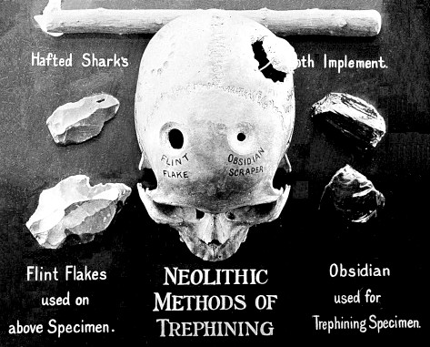 Neolithic Trepanning Tools