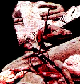 suturing_wound_the_gross_clinic_thomas_e