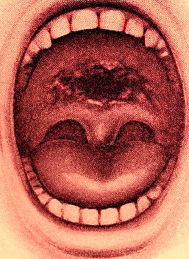 Syphilitic Mouth Ulcer
