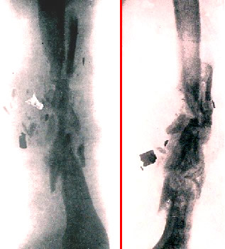 X-Ray of Shattered Bone and Fragments