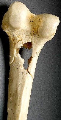 Gunshot Through Femur