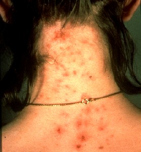 Louse Bites