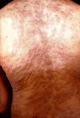 Secondary Stage Syphilitic Rash