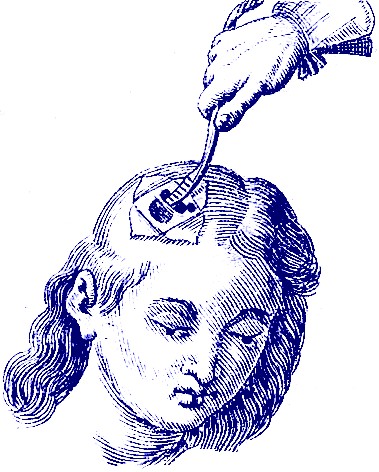 Elevating the Skull, Scultetus