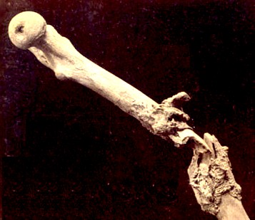 Bone Exfoliation