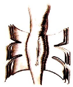 Fracture Wound With Swelling