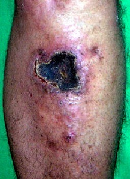 Gangrened Wound